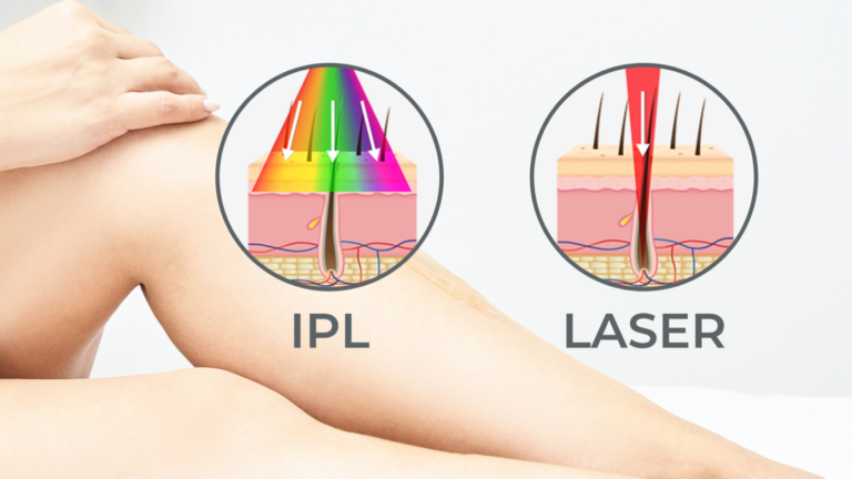 Лазер vs IPL — какой метод эпиляции эффективнее?
